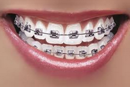 dentists for kids dental braces