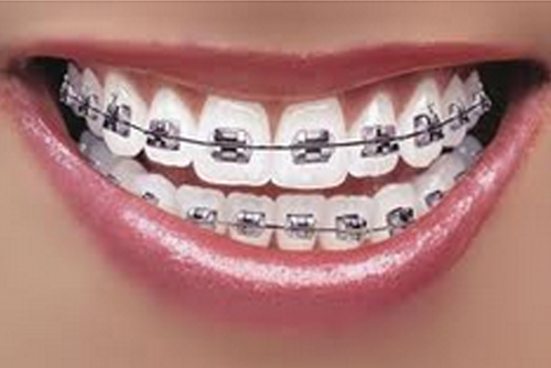 dentists for kids dental braces dentists for kids dental braces