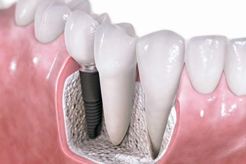 dental implants