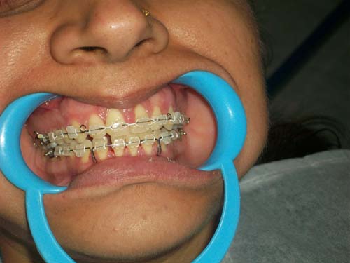 dentists for kids dental braces