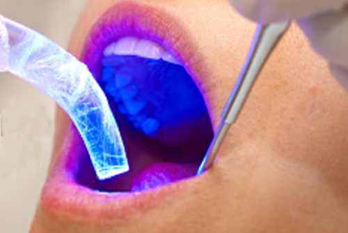 laser gum surgery