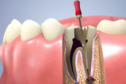 root canals
