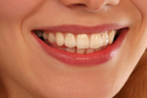 smile designing
